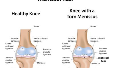 How to heal a torn meniscus naturally: Effective strategies