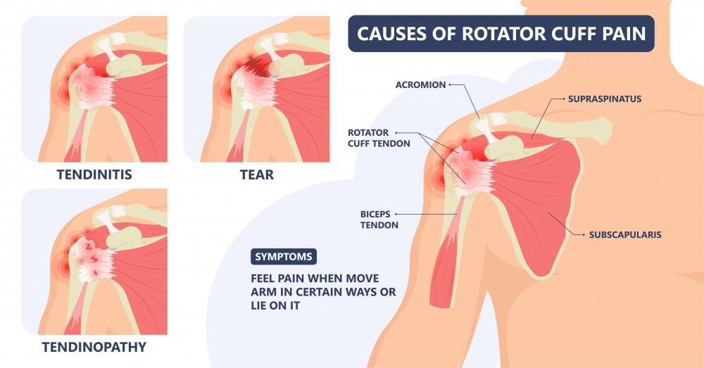 How to tell if you have a torn rotator cuff