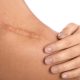 How to break up scar tissue: Effective methods