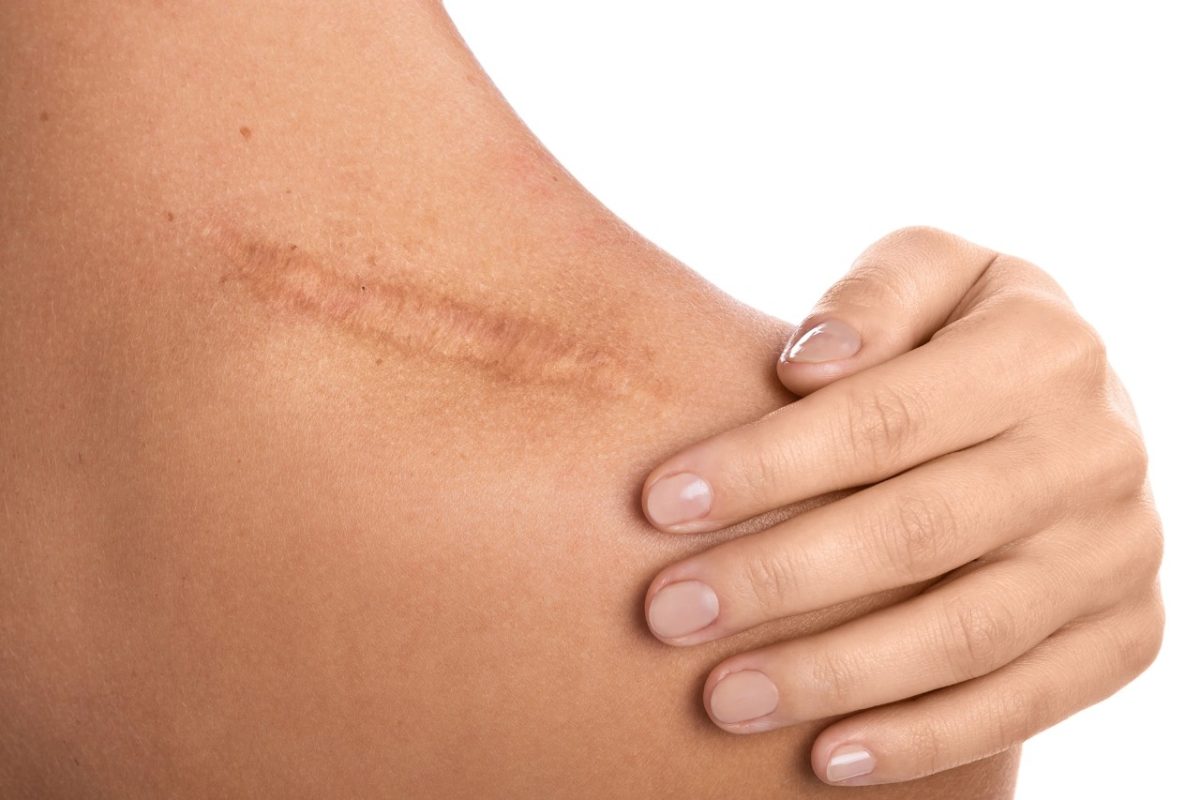 How to break up scar tissue: Effective methods